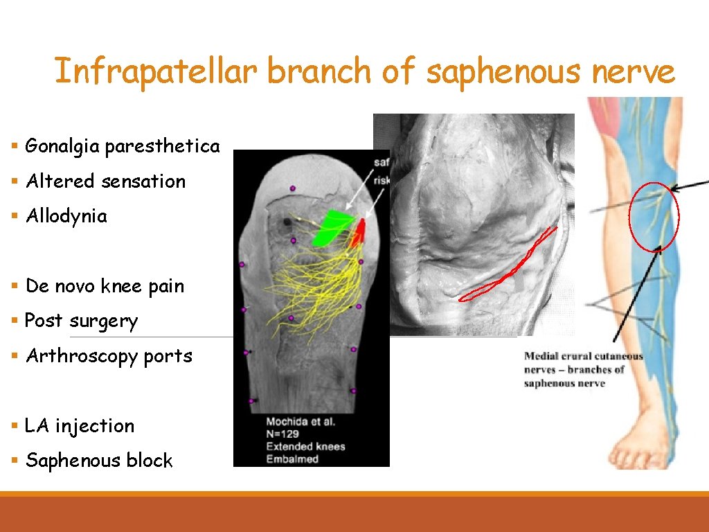 Infrapatellar branch of saphenous nerve § Gonalgia paresthetica § Altered sensation § Allodynia §