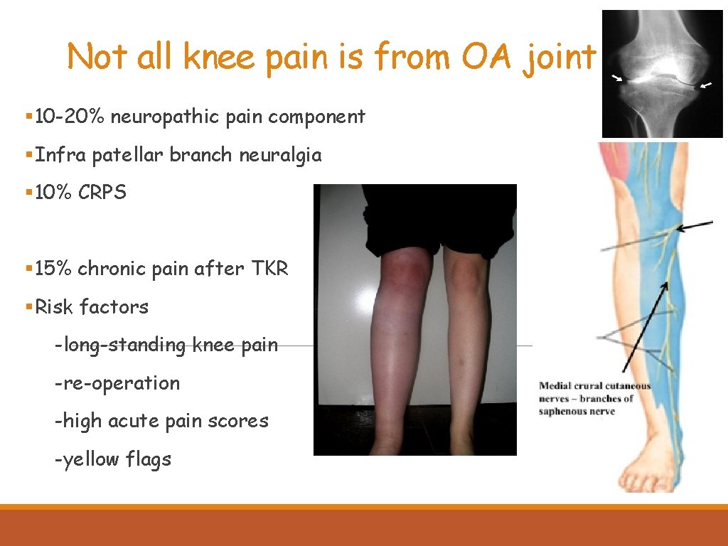 Not all knee pain is from OA joint § 10 -20% neuropathic pain component