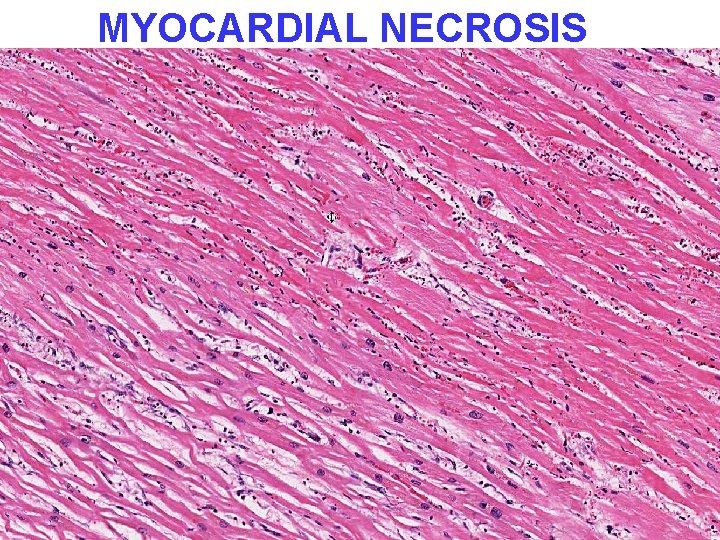 MYOCARDIAL NECROSIS 