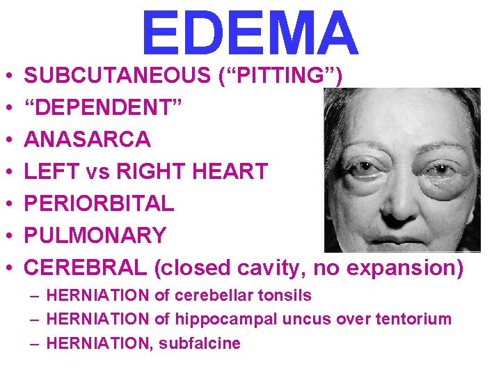 • • EDEMA SUBCUTANEOUS (“PITTING”) “DEPENDENT” ANASARCA LEFT vs RIGHT HEART PERIORBITAL PULMONARY