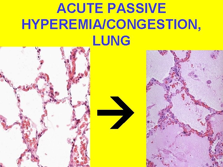 ACUTE PASSIVE HYPEREMIA/CONGESTION, LUNG 