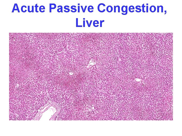 Acute Passive Congestion, Liver 