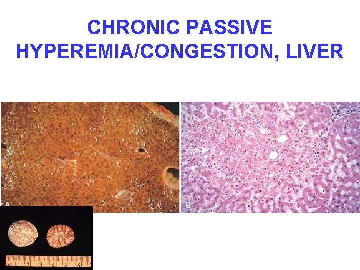 CHRONIC PASSIVE HYPEREMIA/CONGESTION, LIVER 