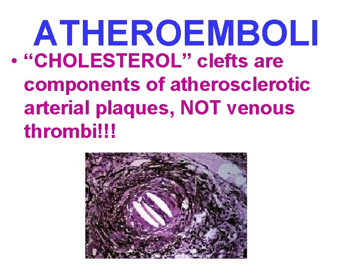 ATHEROEMBOLI • “CHOLESTEROL” clefts are components of atherosclerotic arterial plaques, NOT venous thrombi!!! 