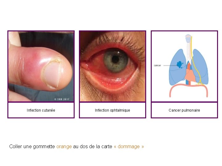 Infection cutanée Infection ophtalmique Coller une gommette orange au dos de la carte «