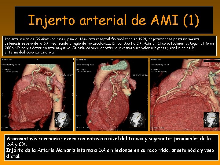 Injerto arterial de AMI (1) Paciente varón de 59 años con hiperlipemia. IAM anteroseptal