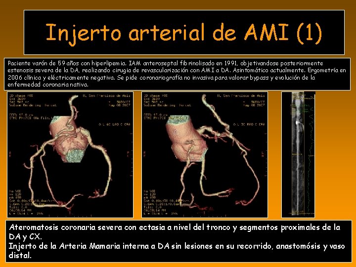 Injerto arterial de AMI (1) Paciente varón de 59 años con hiperlipemia. IAM anteroseptal