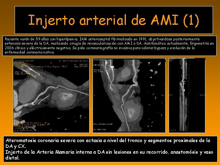 Injerto arterial de AMI (1) Paciente varón de 59 años con hiperlipemia. IAM anteroseptal