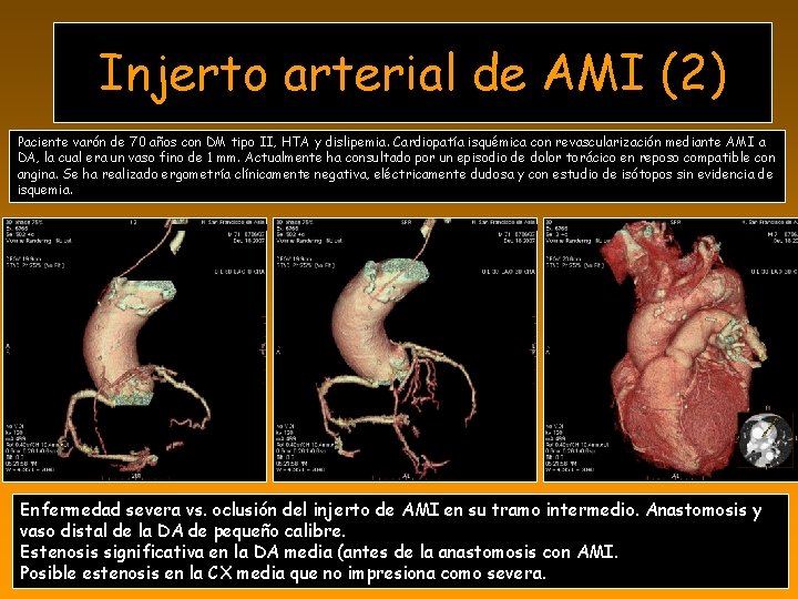 Injerto arterial de AMI (2) Paciente varón de 70 años con DM tipo II,