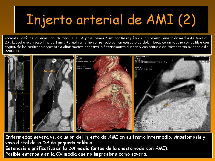 Injerto arterial de AMI (2) Paciente varón de 70 años con DM tipo II,