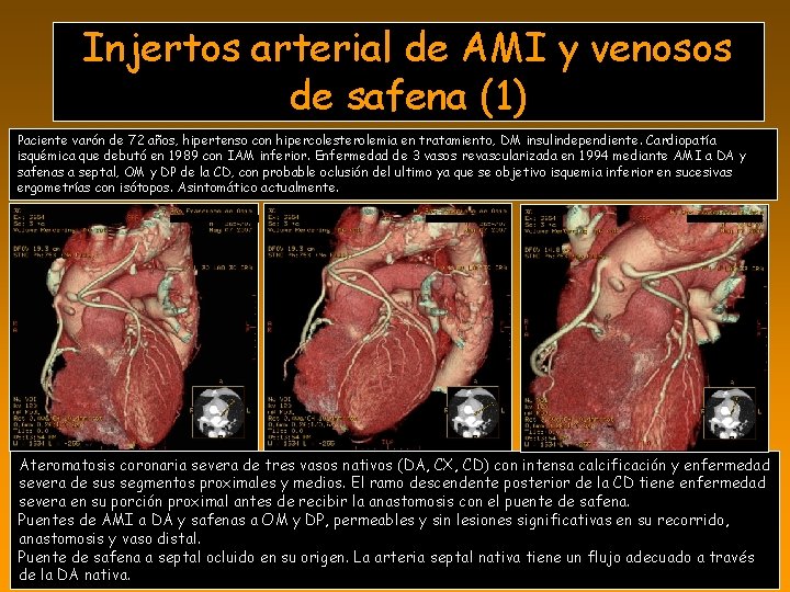 Injertos arterial de AMI y venosos de safena (1) Paciente varón de 72 años,