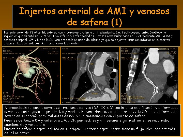 Injertos arterial de AMI y venosos de safena (1) Paciente varón de 72 años,