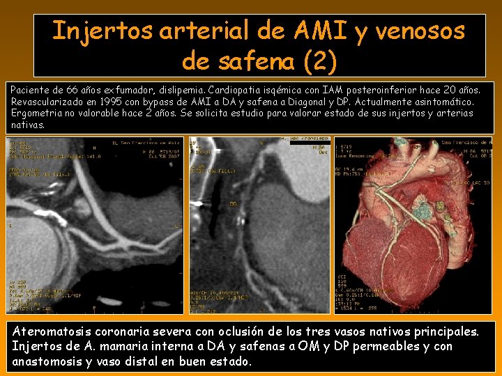 Injertos arterial de AMI y venosos de safena (2) Paciente de 66 años exfumador,