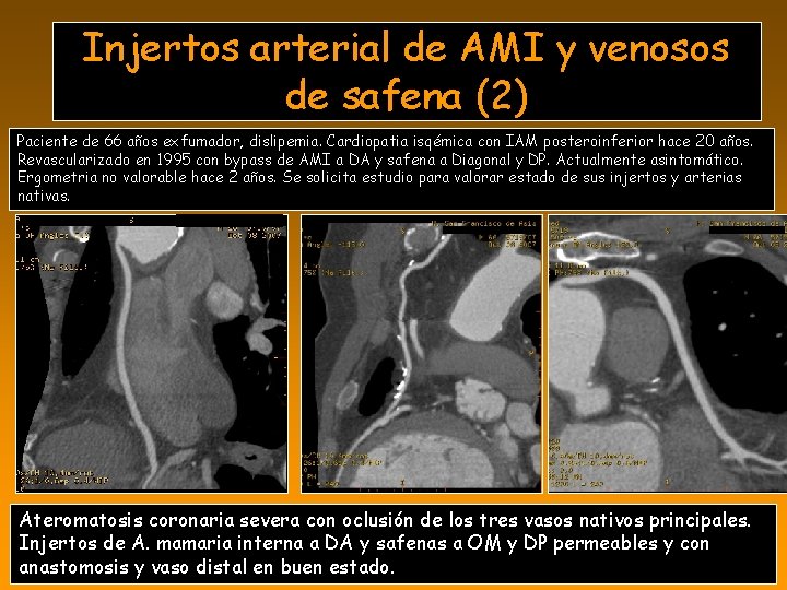 Injertos arterial de AMI y venosos de safena (2) Paciente de 66 años exfumador,