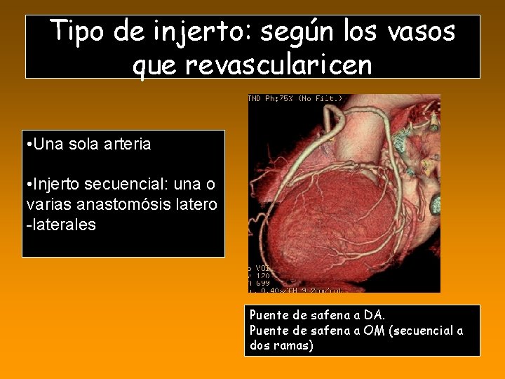 Tipo de injerto: según los vasos que revascularicen • Una sola arteria • Injerto