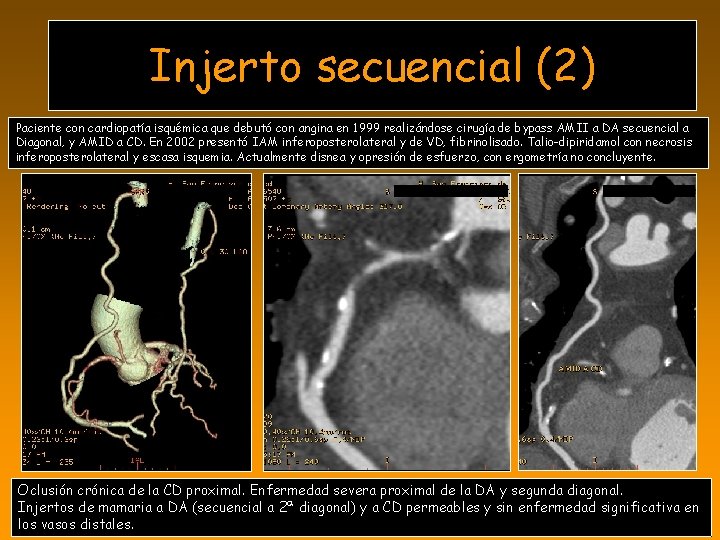 Injerto secuencial (2) Paciente con cardiopatía isquémica que debutó con angina en 1999 realizándose