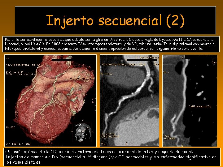 Injerto secuencial (2) Paciente con cardiopatía isquémica que debutó con angina en 1999 realizándose