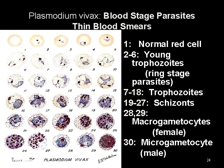 Plasmodium vivax: Blood Stage Parasites Thin Blood Smears 1: Normal red cell 2 -6: