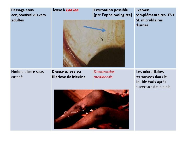 Passage sous conjonctival du vers adultes loase à Loa loa Extirpation possible Examen (par