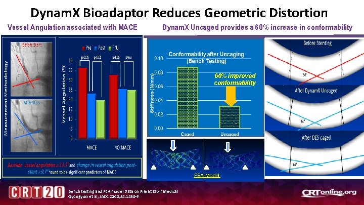 Dynam. X Bioadaptor Reduces Geometric Distortion Vessel Angulation associated with MACE Dynam. X Uncaged