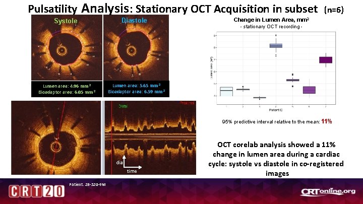 Pulsatility Analysis : Stationary OCT Acquisition in subset Systole Lumen area: 4. 96 mm