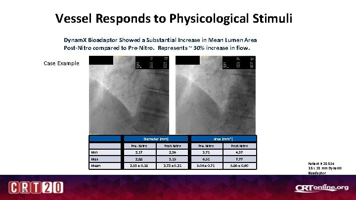 Vessel Responds to Physicological Stimuli Dynam. X Bioadaptor Showed a Substantial Increase in Mean