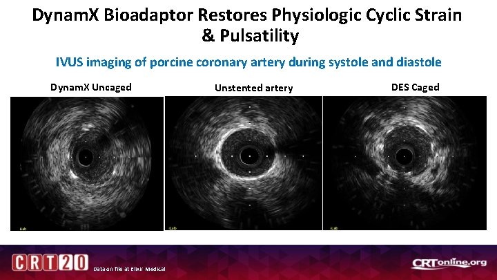 Dynam. X Bioadaptor Restores Physiologic Cyclic Strain & Pulsatility IVUS imaging of porcine coronary