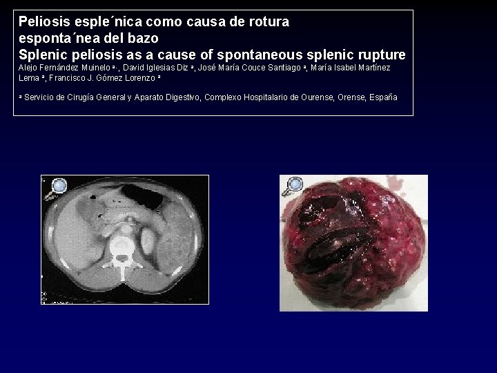 Peliosis esple´nica como causa de rotura esponta´nea del bazo Splenic peliosis as a cause