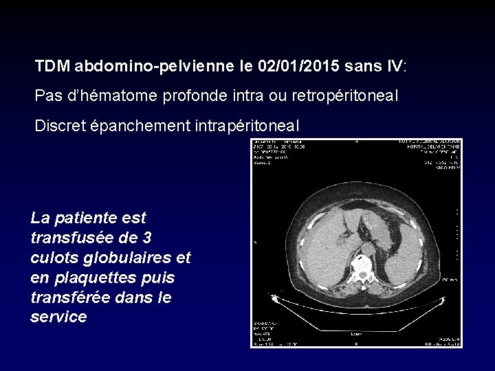 TDM abdomino-pelvienne le 02/01/2015 sans IV: Pas d’hématome profonde intra ou retropéritoneal Discret épanchement