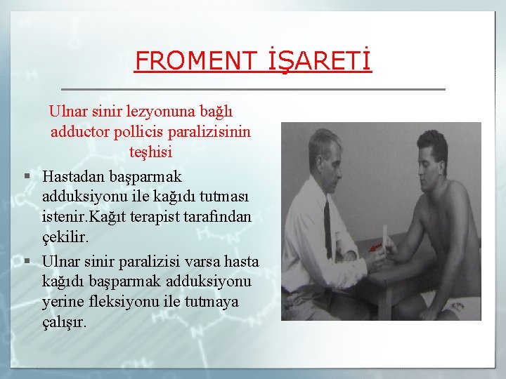 FROMENT İŞARETİ Ulnar sinir lezyonuna bağlı adductor pollicis paralizisinin teşhisi § Hastadan başparmak adduksiyonu