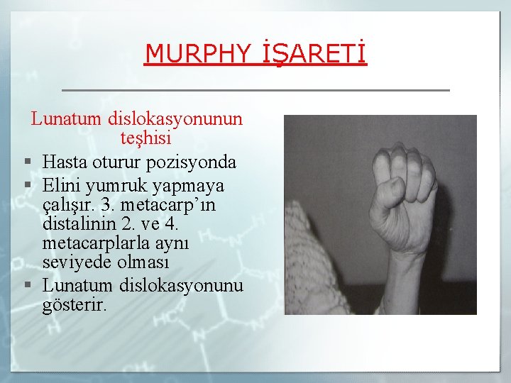 MURPHY İŞARETİ Lunatum dislokasyonunun teşhisi § Hasta oturur pozisyonda § Elini yumruk yapmaya çalışır.