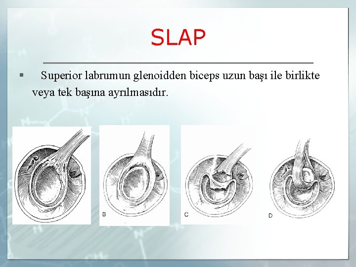 SLAP § Superior labrumun glenoidden biceps uzun başı ile birlikte veya tek başına ayrılmasıdır.