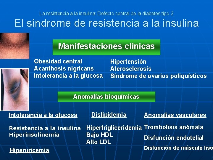 La resistencia a la insulina: Defecto central de la diabetes tipo 2 El síndrome