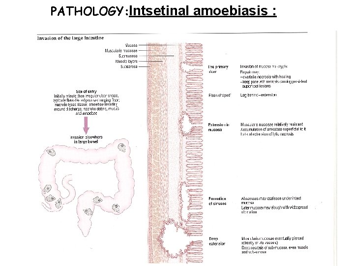 PATHOLOGY: Intsetinal amoebiasis : 