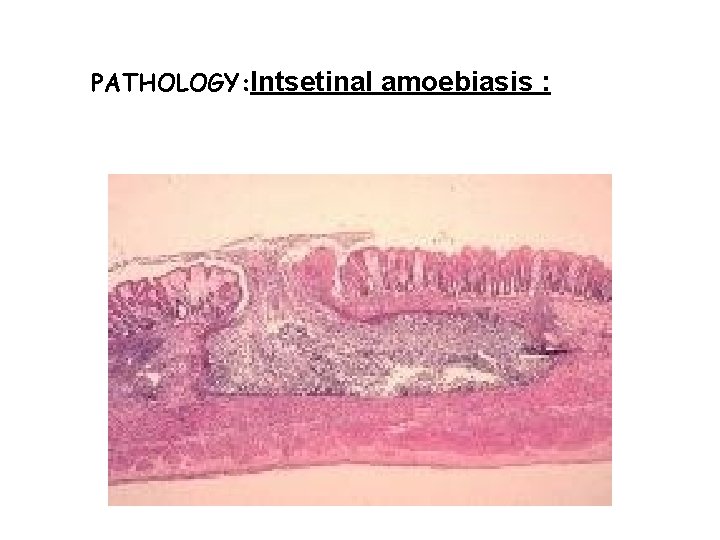 PATHOLOGY: Intsetinal amoebiasis : 