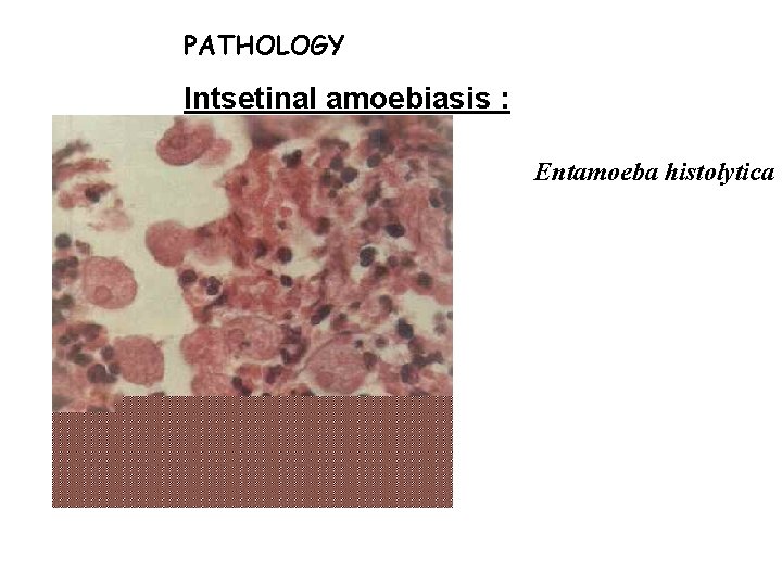 PATHOLOGY Intsetinal amoebiasis : Entamoeba histolytica 