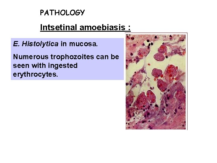 PATHOLOGY Intsetinal amoebiasis : E. Histolytica in mucosa. Numerous trophozoites can be seen with