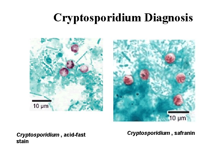 Cryptosporidium Diagnosis Cryptosporidium , acid-fast stain Cryptosporidium , safranin 