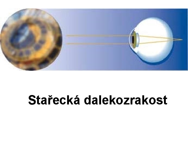 Stařecká dalekozrakost 