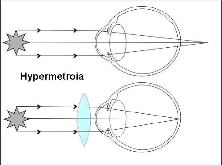 Hypermetroia 