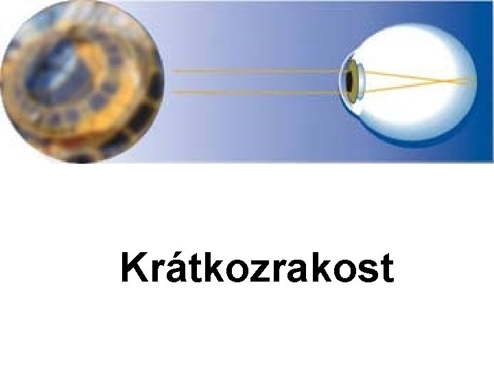 Krátkozrakost 