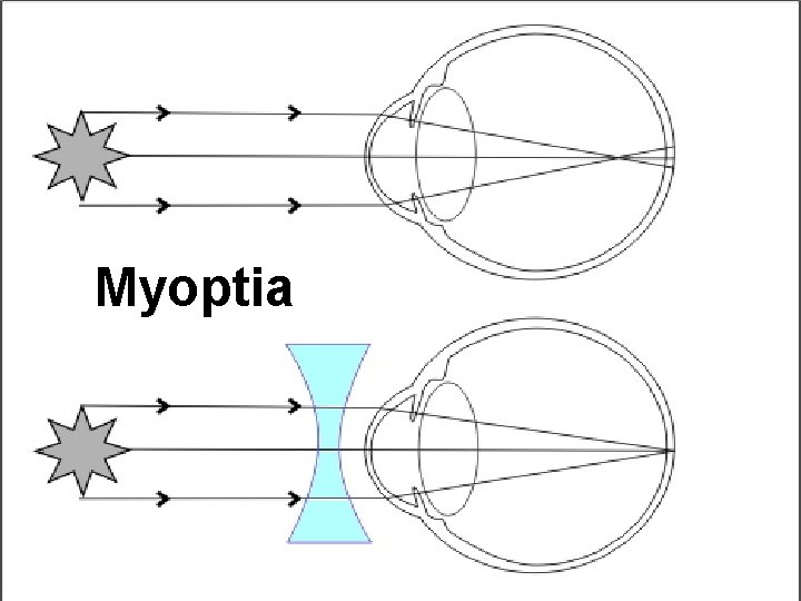 Myoptia 