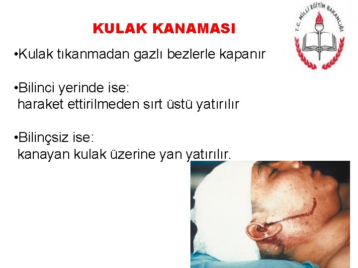 KULAK KANAMASI • Kulak tıkanmadan gazlı bezlerle kapanır • Bilinci yerinde ise: haraket ettirilmeden