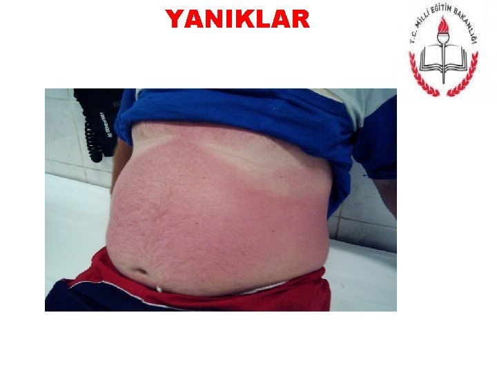 YANIKLAR 