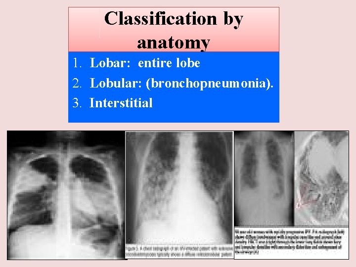 Classification by anatomy 1. Lobar: entire lobe 2. Lobular: (bronchopneumonia). 3. Interstitial 