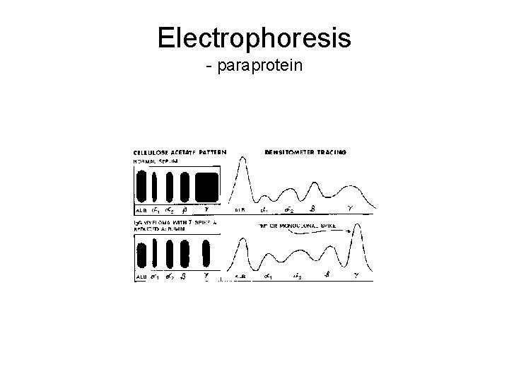 Electrophoresis - paraprotein 