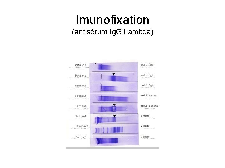 Imunofixation (antisérum Ig. G Lambda) 