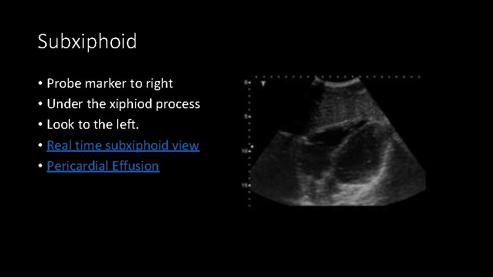 Subxiphoid • Probe marker to right • Under the xiphiod process • Look to