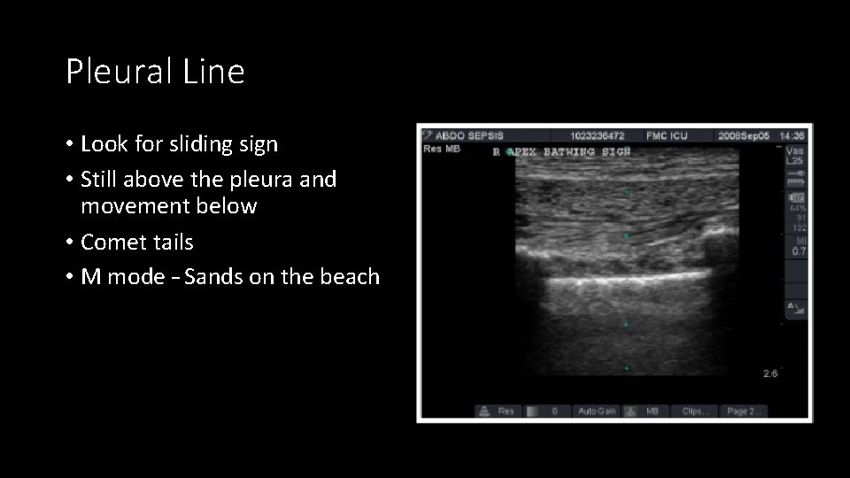Pleural Line • Look for sliding sign • Still above the pleura and movement