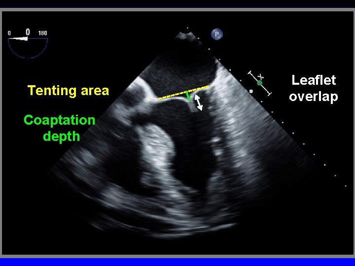 Tenting area Coaptation depth Leaflet overlap 